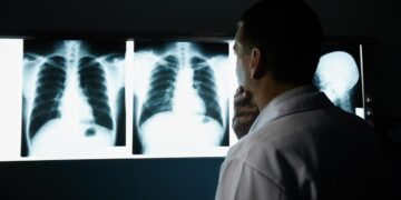 La Comunidad de Madrid participa en un ensayo que cambia el paradigma de tratamiento del cáncer de pulmón en estadios intermedios